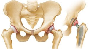 Read more about the article Complex Hip Replacement