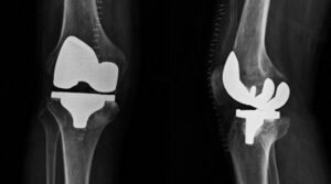 Read more about the article Primary Knee Replacement