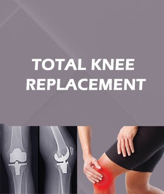 total knee repalcement